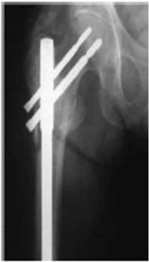 FULL TEXT - A prospective study to evaluate the outcome of operative  treatment of patients with intertrochanteric fracture of femur with cephalomedullary  nail and dynamic hip screw device - Edorium Journal of Orthopedics